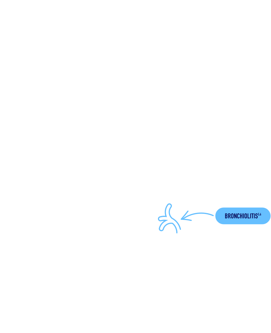 Illustration of respiratory track showing points where RSV infection symptoms could occur.